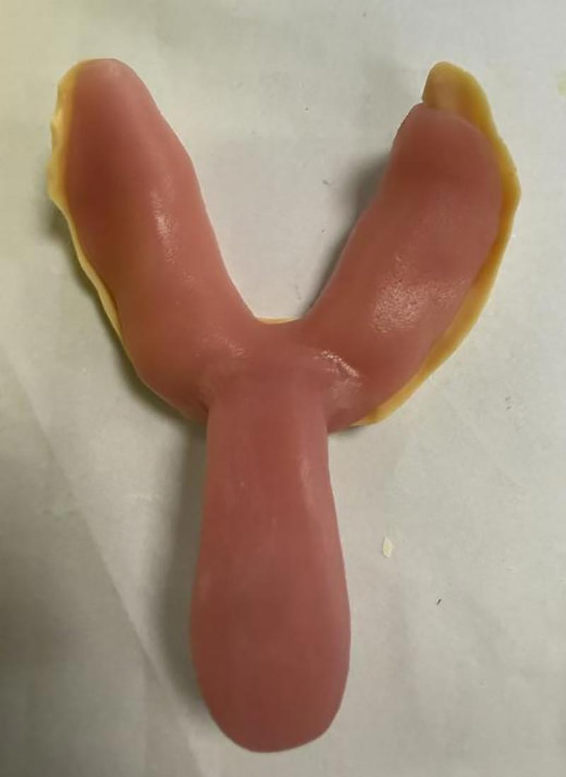 कस्टम डेंटल ट्रे के बारे में वो बातें जो आप नहीं जानते होंगे