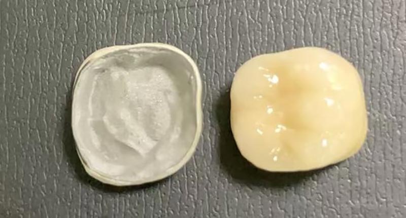 जब आपका पोर्सिलेन क्राउन चिप्स हो जाए तो क्या करें? यहां बताया गया है कि ऐसा क्यों होता है और इसे कैसे ठीक किया जाए