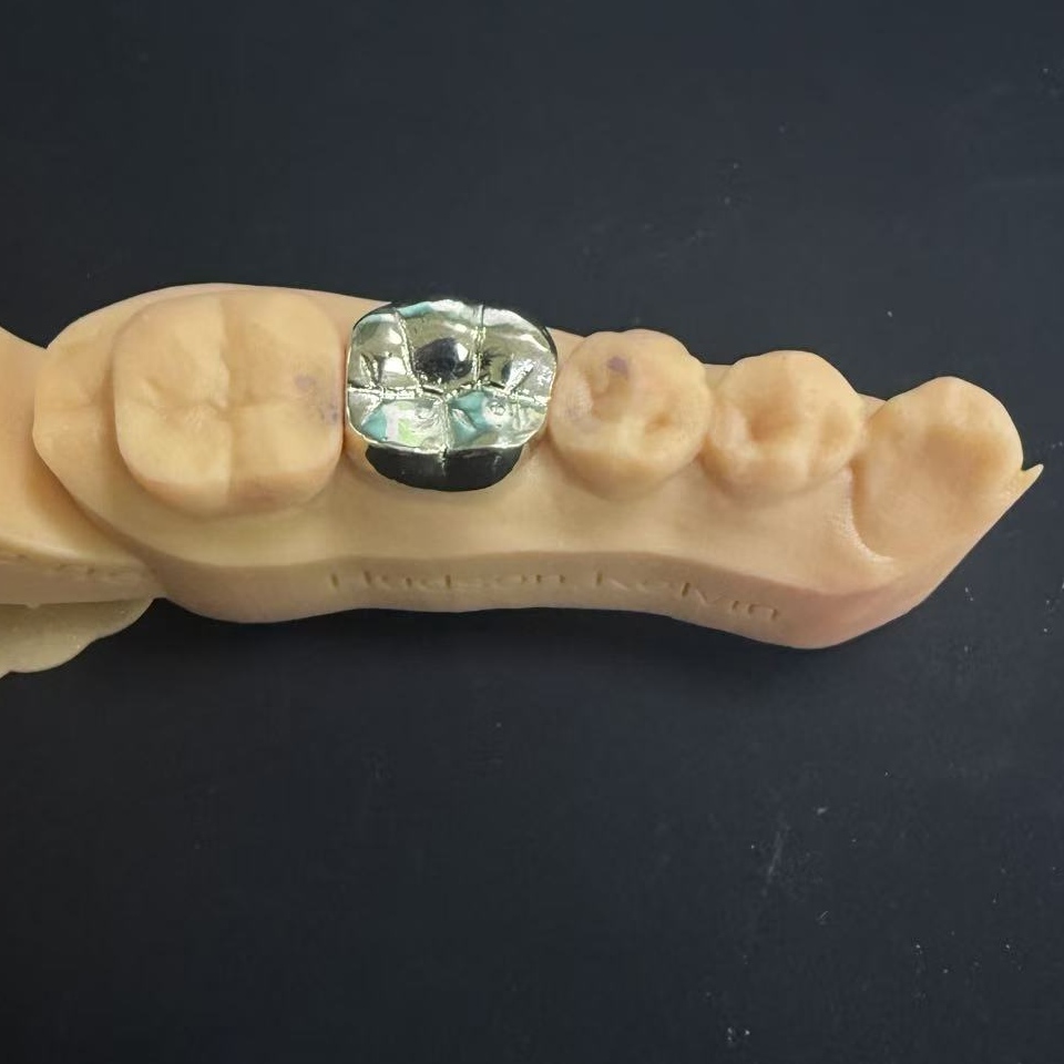 सोने के मुकुट: आजीवन दंत चिकित्सा बहाली के लिए कीमती धातु का विकल्प