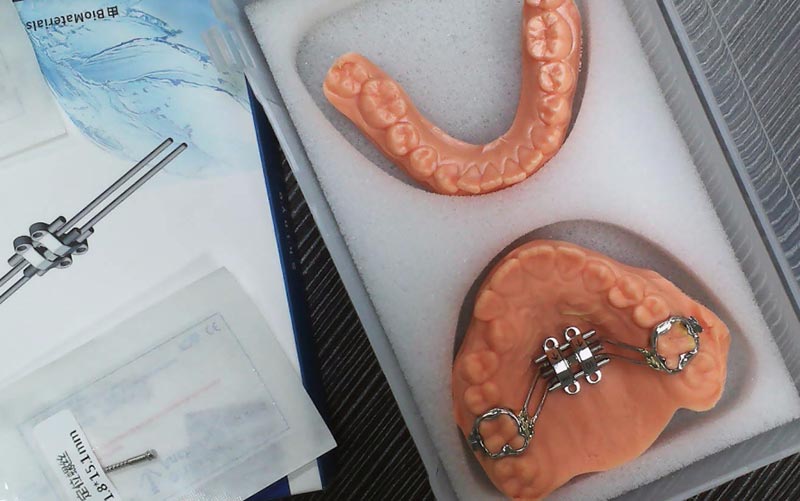 डब्ल्यूएम डेंटल लैब के साथ एमएसई स्केलेटल एक्सपेंशन को समझें