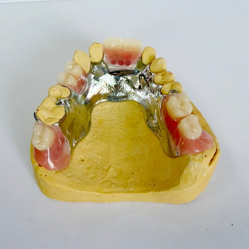 हटाने योग्य पुनर्स्थापन आंशिक ढाँचा